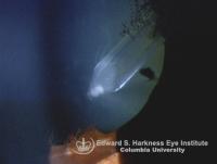 Localized lens opacity caused by the glaucoma filtration tube trauma.